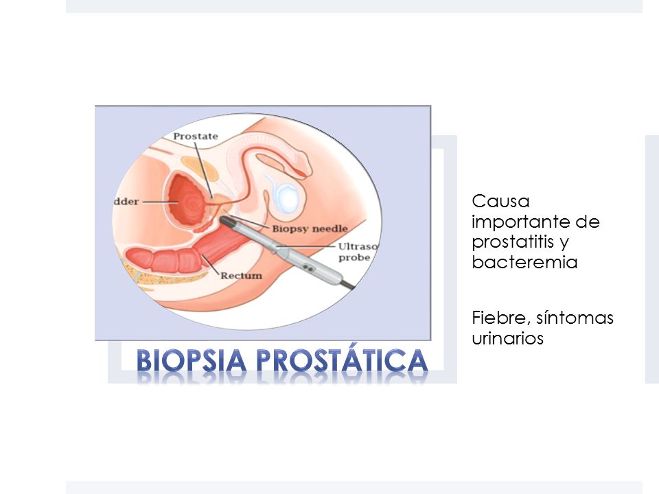 prostatite post biopsia prostatite post biopsia